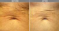 Chicago Laser Tummy Tuck Wrinkle Reduction